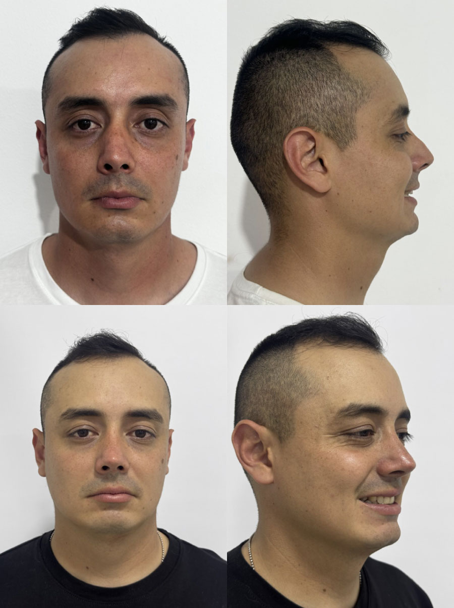 Rinoplastia caso 1