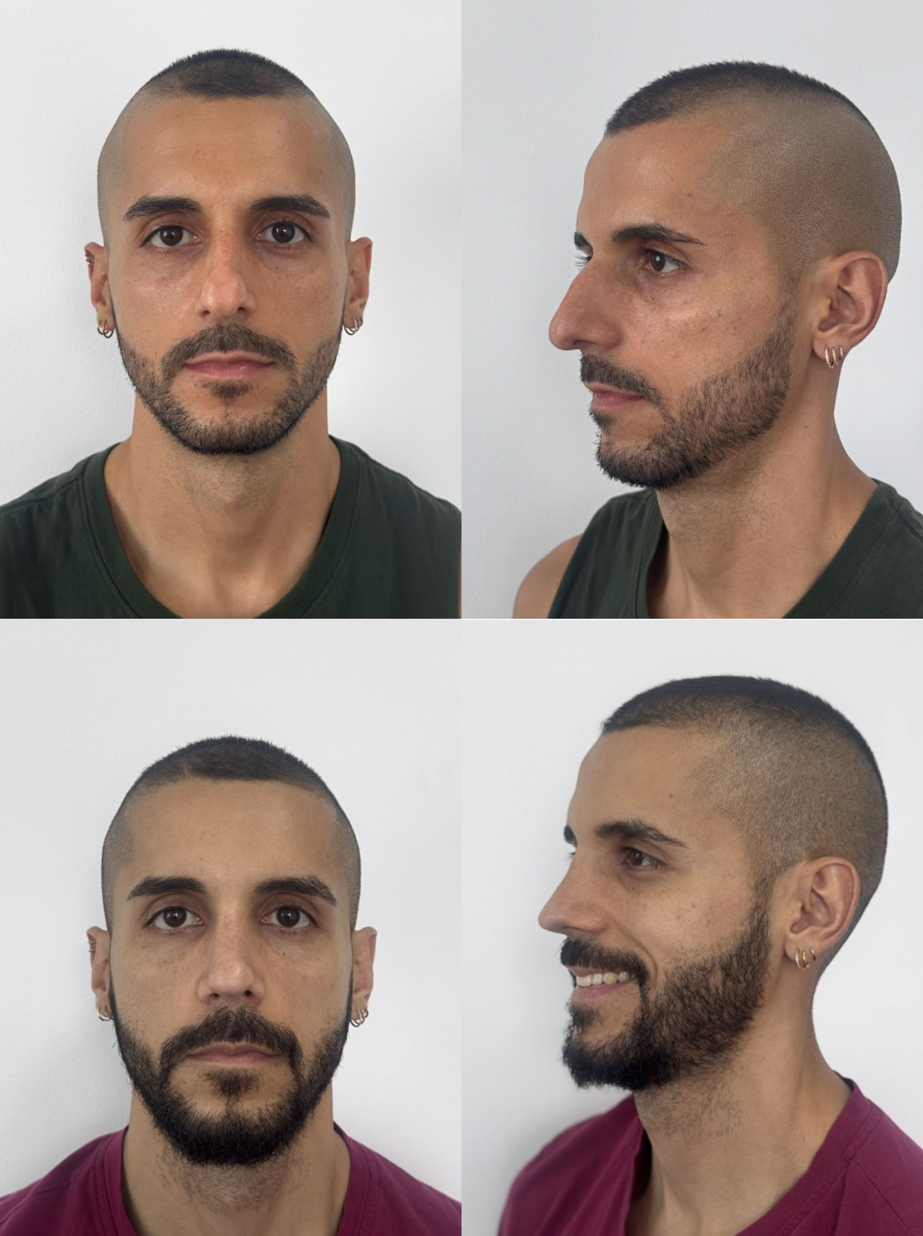 Rinoplastia caso 2