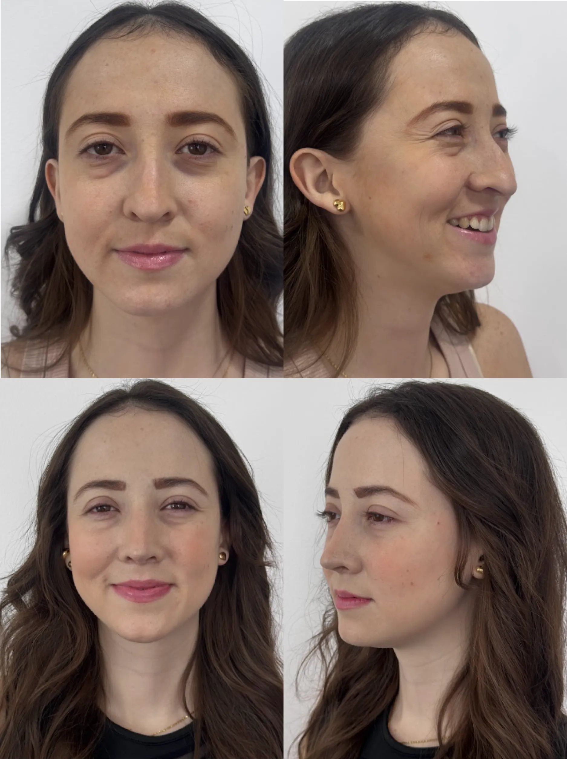 Rinoplastia caso 3